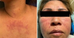 من تجميل إلى مرض نادر.. صدمة تصيب امرأة بعد 15 شهراً من الوشم