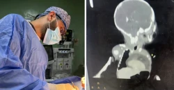 لم يُسجل منها سوى 22 حالة بالعالم..  نجاح أول عملية نادرة لطفلة حديثة الولادة بالعراق