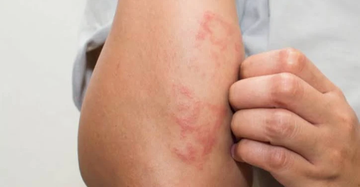 Akıllı dövme tekniğiyle melanoma tespiti