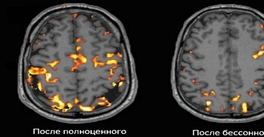 3 أنماط نوم تسرّع شيخوخة الدماغ وترفع خطر الخرف