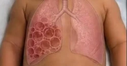 Kirkuk surgeons remove malformed lung lobe from newborn