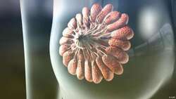 Kurdistan records a reduction in the rate of breast cancer